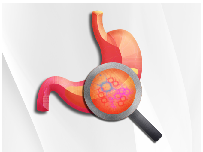Gut Zoomer Stool Test with Meta-Omics Analysis

What is the Gut Zoomer?

The Gut Zoomer Test from Vibrant Wellness offers a comprehensive gut microbiome analysis of overall gut health. By measuring pathogens located in the gastrointestinal system, it is able to determine the microorganisms that may cause chronic diseases. The Gut Zoomer Test can determine three different types of dysbiosis:

The dysbiotic gut microbiome caused by the loss or absence of good microorganisms
The overgrowth of opportunistic bac